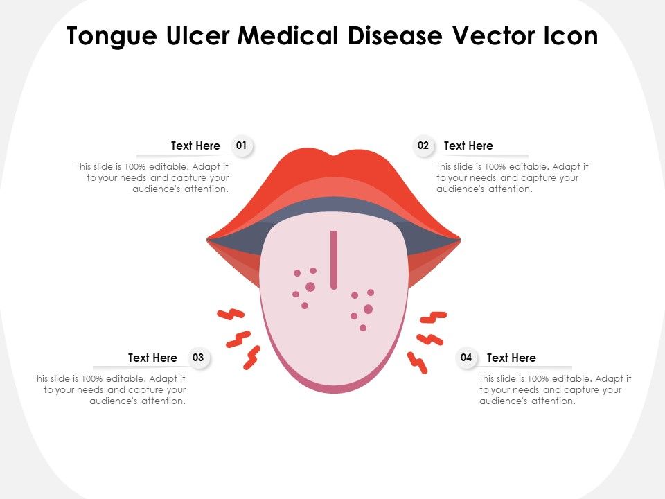 Tongue_Ulcer_Medical_Disease_Vector_Icon_Ppt_PowerPoint_Presentation_File_Graphics_Download_PDF_Slide_1.jpg