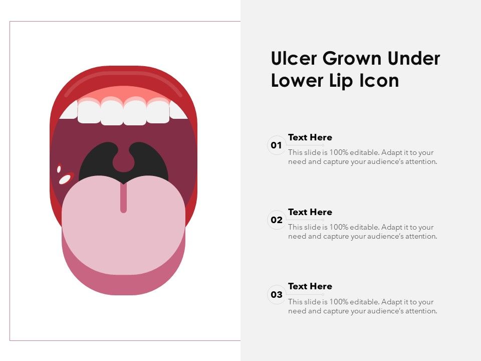 Ulcer_Grown_Under_Lower_Lip_Icon_Ppt_PowerPoint_Presentation_Gallery_Show_PDF_Slide_1.jpg