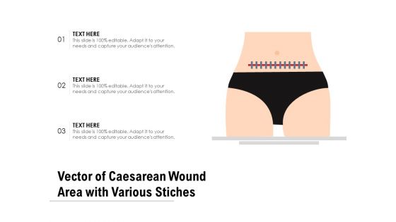 Vector Of Caesarean Wound Area With Various Stiches Ppt PowerPoint Presentation Summary Images PDF