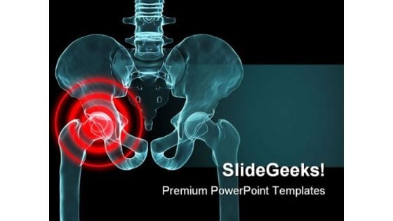 Arthritis In Hip Medical PowerPoint Themes And PowerPoint Slides 0211