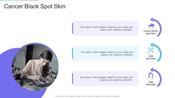 Cancer Black Spot Skin In Powerpoint And Google Slides Cpb