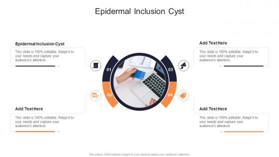 Epidermal Inclusion Cyst In Powerpoint And Google Slides Cpb