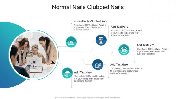 Normal Nails Clubbed Nails In Powerpoint And Google Slides Cpb
